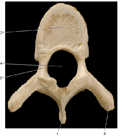 -In the above superior view of a vertebra,number 5 indicates what bony landmark?