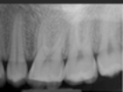 <strong>Identify this image;it is mounted using the labial view. </strong> A)Maxillary right molars B)Maxillary left premolars C)Maxillary left molars D)Mandibular left molars