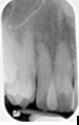 <strong>Identify this image;it is mounted using the labial view. </strong> A)Maxillary right canine B)Maxillary left canine C)Maxillary right incisors D)Maxillary left incisors