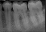 <strong>Identify the major placement error in this molar radiograph. </strong> A)Too far mesial B)Too far distal C)Vertical angulation D)Horizontal angulation