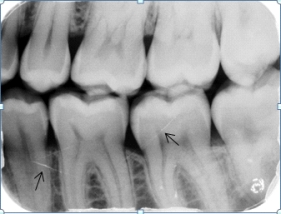 <strong>Identify the cause of the lines the arrows are pointing to on your patient's dental image. </strong> A)Fractures in the root and crown B)Scratched film emulsion C)Artifacts on the phosphor plates D)Streaks of light