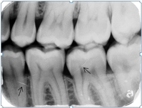 <strong>Identify the cause of the lines the arrows are pointing to on your patient's dental image. </strong> A)Fractures in the root and crown B)Scratched film emulsion C)Artifacts on the phosphor plates D)Streaks of light