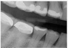 <strong>Identify the major technique error on your patient's bitewing. </strong> A)Overlap B)Vertical angulation C)Cone-cut D)Occlusal plane not centered