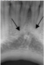 <strong>Identify this landmark. </strong> A)Genial tubercles B)Mental ridge C)Mental fossa D)Mylohyoid ridge