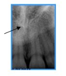 <strong>Identify this landmark. </strong> A)Incisive foramen B)Nasal fossa C)Nasal septum D)Nasal spine