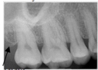 <strong>Identify this landmark on your patient's dental image. </strong> A)Lateral pterygoid plate B)Maxillary tuberosity C)Zygoma D)Maxillary sinus