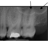 <strong>Identify this landmark. </strong> A)Maxillary tuberosity B)Zygoma C)Maxillary sinus D)Mylohyoid bone