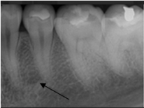 <strong>What is the arrow pointing to on your patient's dental image? </strong> A)Periapical abscess B)Trabecular bone C)Mental foramen D)Periodontal abscess