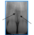 <strong>Identify the landmark the arrows are pointing to on your patient's dental image. </strong> A)Nose B)Incisive foramen C)Midpalatine suture D)Lateral fossa