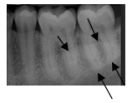 <strong>Identify this landmark. </strong> A)External oblique ridge B)Submandibular fossa C)Mylohyoid ridge D)Mandibular canal