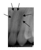 <strong>What are the arrows pointing to? </strong> A)Periodontal abscess B)Incisive foramen C)Lateral fossa D)Periapical abscess