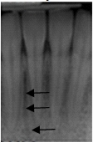 <strong>Identify the radiolucent area the arrows are pointing to. </strong> A)Mental fossa B)Periodontal pocket C)Mental ridge D)Nutrient canal