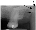 <strong>Identify the radiopaque area the arrows are pointing to. </strong> A)Maxillary tuberosity B)Coronoid process C)Condyle D)Spine