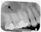 <strong>Identify the radiopaque area the arrows are pointing to. </strong> A)Maxillary sinus B)Lateral pterygoid plate C)Orbit D)Zygoma