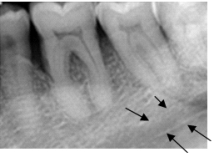 <strong>Identify the area the arrows are pointing to on your patient's dental image. </strong> A)Mandibular canal B)Submandibular fossa C)Mylohyoid ridge D)Border of the mandible