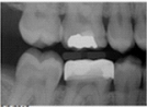 Identify the restoration your patient has on tooth number 30.  