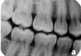 <strong>Identify the type of decay present that your patient has on the mesial of tooth number 4. </strong> A)Incipient interproximal caries B)Moderate interproximal caries C)Advanced interproximal caries D)Severe interproximal caries