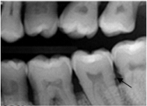 <strong>Identify the radiopaque area the arrow is pointing to on your patient's dental image. </strong> A)Calculus B)Caries C)Cemento-enamel junction D)Cementum
