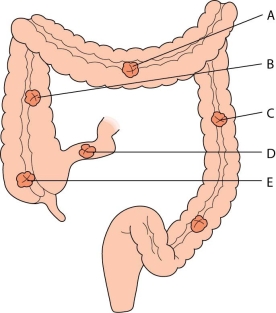 <strong>The nurse is caring for a client with colorectal cancer who is post-operative from a transverse colostomy placement.What area of the bowel is involved? </strong> A) A B) B C) C D) D E) E