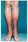 <strong>A nurse is caring for a client diagnosed with Erysipelas whose lower extremities are bright red and raised with well-defined borders.(See image.)Which is the most likely causative organism of this condition? </strong> A) Group B streptococcus. B) Group A streptococcus. C) Staphylococcus aureus. D) Candida albicans.