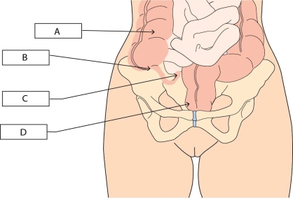 <strong> A nurse checking for tenderness at McBurney's point for a client with suspected appendicitis will palpate which area?</strong> A) A B) B C) C D) D