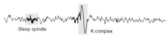 <strong> Which stage of sleep EEG is illustrated here?</strong> A) stage 1 B) stage 2 C) stage 3 D) stage 4 E) REM