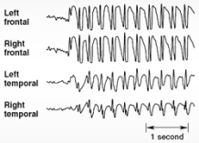 <strong>Illustrated here are EEG discharges characteristic of </strong> A) absence seizures. B) tonic-clonic seizures. C) simple partial seizures. D) complex partial seizures. E) myoclonic seizures.
