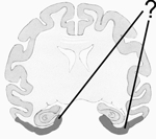 <strong>Here is an illustration of coronal section of a monkey brain cut through the hippocampus and amygdala. The shaded area indicates the position of the </strong> A) hippocampus. B) rhinal cortex portion of the medial temporal cortex. C) amygdala. D) parietal cortex. E) none of the above