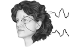 <strong>Illustrated here is </strong> A) electroencephalography. B) magnetoencephalography. C) electrooculography. D) plethysmography. E) electromyography.
