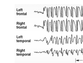 <strong>Illustrated here are EEG discharges characteristic of </strong> A) absence seizures. B) tonic-clonic seizures. C) simple partial seizures. D) complex partial seizures. E) myoclonic seizures.