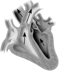 <strong>Which of the following describes the stage of the cardiac cycle shown? </strong> A)AV valves closed,SL valves open,ventricles contracting B)AV valves open,SL valves closed,ventricles contracting C)AV valves closed,SL valves open,ventricles relaxed D)AV and SL valves both open,ventricles contracting