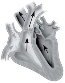 <strong>Which of the following describes the stage of the cardiac cycle shown? </strong> A)AV and SL valves both open, ventricles contracting B)AV valves open, SL valves closed, ventricles contracting C)AV valves closed, SL valves open, ventricles contracting D)AV valves closed, SL valves open, ventricles relaxed