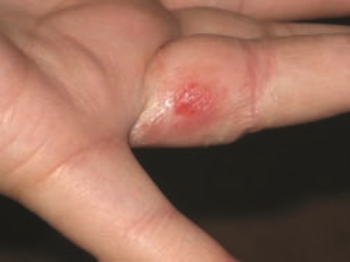 This figure shows a skin reaction that developed as the result of the reaction of the individual to a ring that was not pure gold but was alloyed with nickel. The reaction appeared 2 days after wearing the ring. This rash is