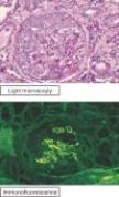 <strong>The figure shows routine histologic and immunofluorescence images of a kidney biopsy specimen taken from a 53-year-old man with acute-onset renal failure and hemoptysis (coughing up blood).The histologic section is notable for glomerular inflammation in a crescentic distribution.Staining,using fluorescently tagged anti-IgG antibody,shows linear deposits of IgG along the glomerular basement membrane.Urinalysis is positive for moderate proteinuria and red cell casts.A chest radiograph shows pulmonary infiltrates.Which of the following is the most likely diagnosis? </strong> A)Systemic lupus erythematosus B)Graves' disease C)Chronic allograft rejection D)Goodpasture's syndrome E)Poststreptococcal glomerulonephritis