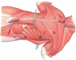 <strong>Identify the serratus dorsalis in the following image.  </strong> A) A B) B C) C D) D <div style=padding-top: 35px> 