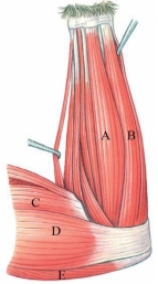 <strong>Identify the muscle labeled A in the following figure.  </strong> A) palmaris longus B) flexor carpi ulnaris C) biceps brachii D) epitrochlearis E) triceps brachii <div style=padding-top: 35px> 