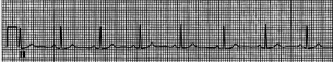 <strong>A patient presents for her annual physical examination in seemingly good health.However,she is concerned about her heart because of family history,and you proceed to work up an examination of cardiovascular function.She has a blood pressure of 128/83 mm Hg,and echocardiography indicates that end-diastolic volume is 140 mL and end-systolic volume is 80 mL.A routine ECG is obtained and is shown as follows: Inspection of the ECG indicates a PR interval of:</strong> A)0.08 seconds B)0.10 seconds C)0.12 seconds D)0.16 seconds E)0.20 seconds