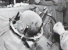 <strong>Select the name of the procedure for which this patient is positioned. </strong> A)Transsphenoidal hypophysectomy B)Infratentorial craniectomy for acoustic neuroma C)Supratentorial stereotactic brain biopsy D)Bilateral parietal craniotomy for subdural hematoma