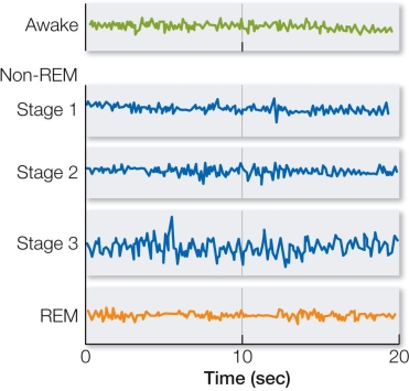 Refer to the figure below.In which of the following electroencephalogram (EEG) recordings does deep, restorative, slow-wave sleep occur?