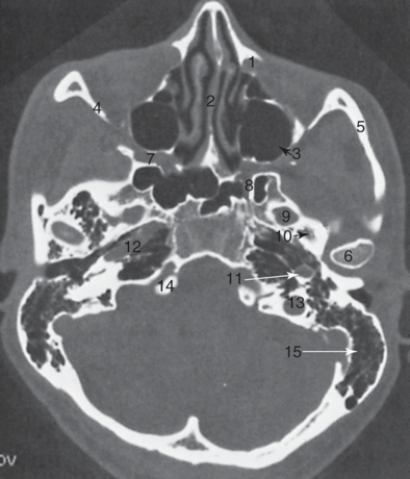 <strong>The structure labeled 6 is the: </strong> A)ascending carotid canal B)lateral orbital wall C)nasal septum D)mandibular condyle
