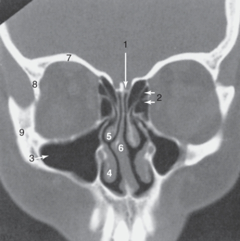 <strong>The structure labeled 3 is the: </strong> A)cribriform plate B)inferior turbinate C)maxillary sinus D)middle turbinate