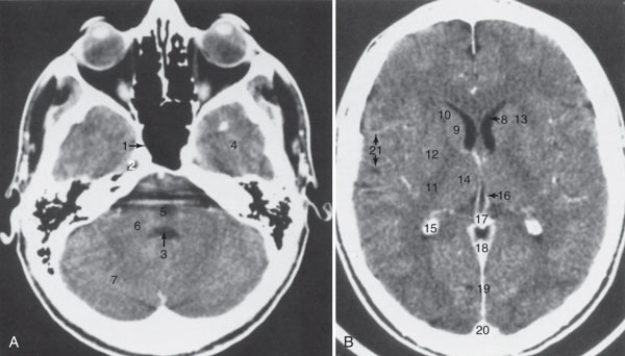 <strong>The structure labeled 15 is the: </strong> A)calcified choroid plexus B)fourth ventricle C)pons D)third ventricle