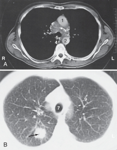 <strong>The structure labeled as 2 is the:  </strong> A)ascending aorta B)descending aorta C)esophagus D)superior vena cava <div style=padding-top: 35px> 