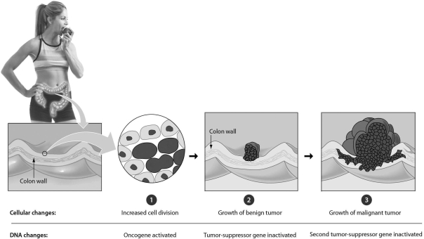 <strong>Examine the figure below.In a typical colon cancer,the first step is ________. </strong> A)the inactivation of a tumor-suppressor gene B)the mutation of a tumor-suppressor gene,producing an oncogene C)the mutation of a proto-oncogene,producing an oncogene D)the conversion of an oncogene to a tumor-suppressor gene