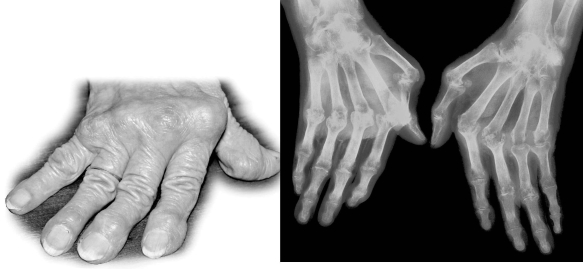<strong>Examine the photograph of the hand in the following figure.The person's joints are severely damaged because ________. </strong> A)the immune system has damaged the cartilage and bone of the joints B)a viral infection has attacked the cartilage of the fingers C)cytotoxic T cells have destroyed the bone in the fingers D)T cells have reacted against the myelin in the hand