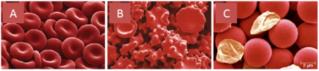 In the pictures below of red blood cells emerged in three different solutions, identify which picture corresponds to each of the following solutions. -Isotonic