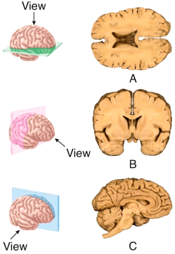 <strong>The section shown in (b)results from cutting through a _______ plane extending through the brain? </strong> A)frontal B)sagittal C)oblique D)midsagittal E)transverse