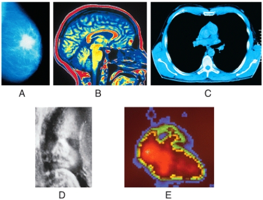 <strong>Which medical image is obtained by using computer assisted interpretation of multiple x-ray arc tracings? </strong> A)(a) B)(b) C)(c) D)(d) E)(e)