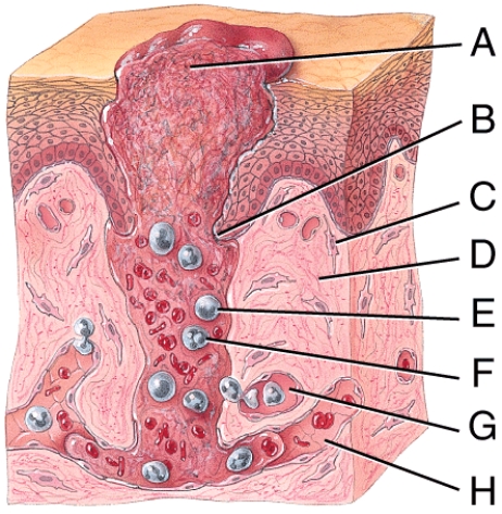 <strong>Which of the following best describes the events occurring at point B in the diagram of deep wound healing shown below? </strong> A)Blood clot is forming. B)New collagen fibers are forming. C)Damaged blood vessels are being repaired. D)Epithelium is migrating across wound. E)Scar tissue is forming.