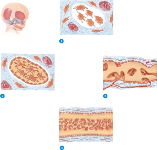 Briefly describe what is happening in each of the numbered stages of intramembranous ossification as observed in a child's skull shown in the diagram below.